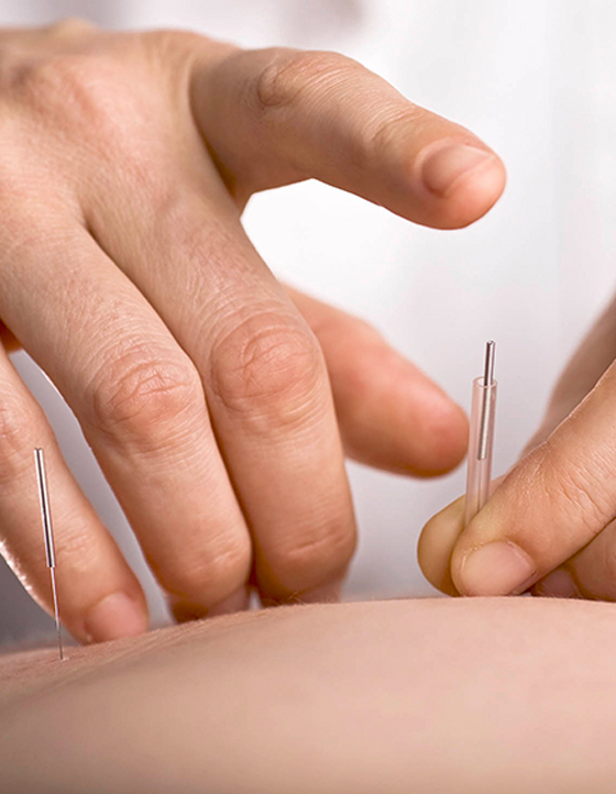 Acupuncture Maribyrnong